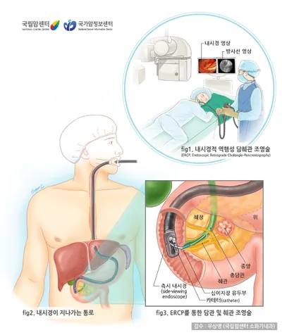 내시경적 역행성 담췌관 조영술