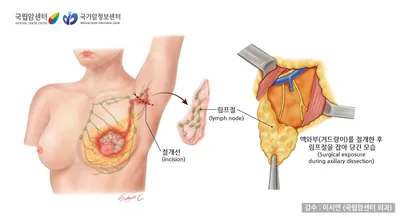 액와부 림프절 곽청술