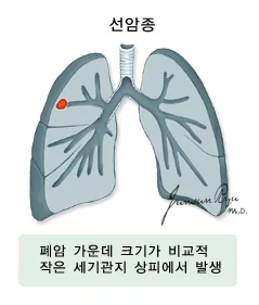 선암종 - 폐암 가운데 크기가 비교적 작은 세기관지 상피에서 발생
