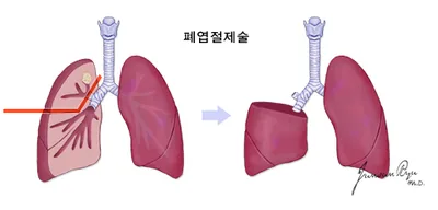 폐엽절제술로 암종이 발생한 폐업 중 하나를 제거한 이미지