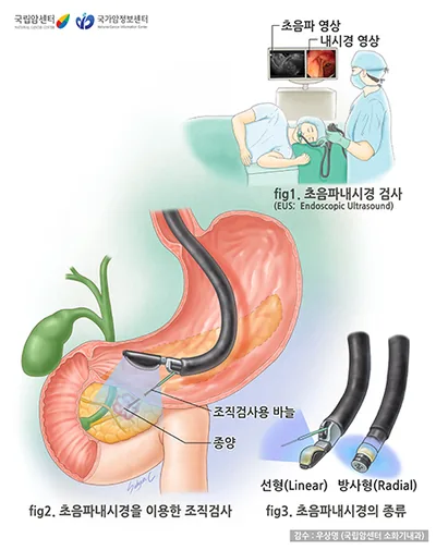 내시경 초음파검사