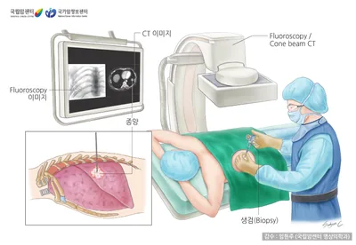 1. 시술 전에 페 병변의 위치를 방사선 검사 등을 이용하여 확인합니다. 2. 시술 직전 검사 중 불편감, 통증 등을 완화하기 위해 시술 부위에 국소마취제를 투여합니다. 3. 초음파, 형광투사, 또는 흉부전산화단층촬영 영상을 확인하면서 가느다란 바늘(세침)로 피부를 뚫고, 종괴 등의 폐병변 부위를 찔러 정확히 바늘 끝이 병변 부위에 위치 시킨 후 주사기로