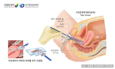 자궁경부세포검사