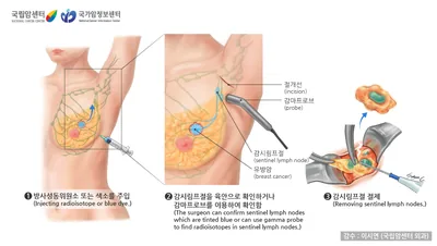 감시림프절 생검술