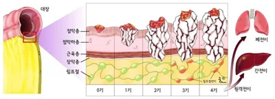 대장암의 병기 - 점막층, 점막하층, 장막, 대장 주위 지방층, 림프절,  1기, 2기, 3기, 4기 : 간, 페, 뇌 등 원격 전이, 절제 불가능한 주위 장기 전이, 애슬러-콜러 병기, A, B1, B2, C1, C2, D
