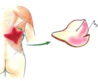 자가조직을 이용한 재건술-등쪽 광배근 피막을 이용한 재건