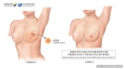 유방 보존적 절제술