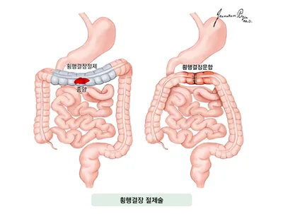 횡행결장 절제술 - 횡행결장절제, 종양, 횡행결장문합