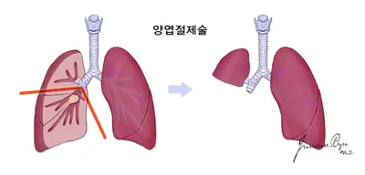 양엽절제술로 오른쪽 두 엽을 제거한 이미지